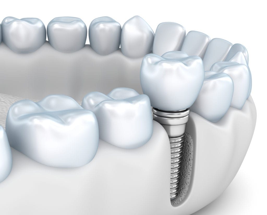 Dental Implants in Glyndon, MD