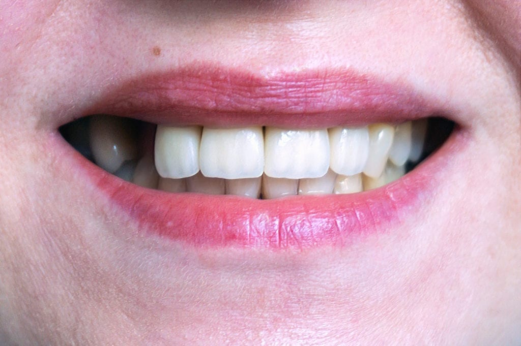 Glyndon, MD treat missing teeth
