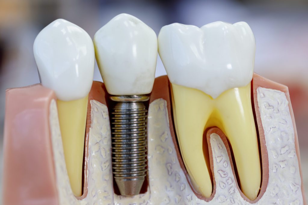affordable dental implants in reisterstown, maryland