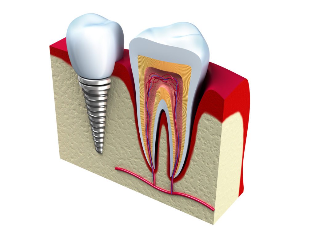 Dental Implants vs Dentures Glyndon MD