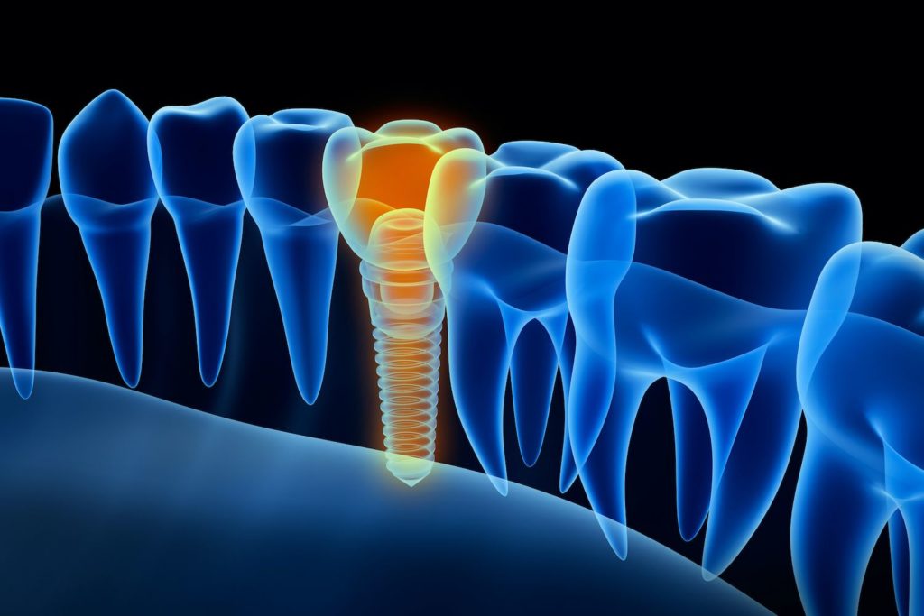 affordable dental implants in butler, maryland