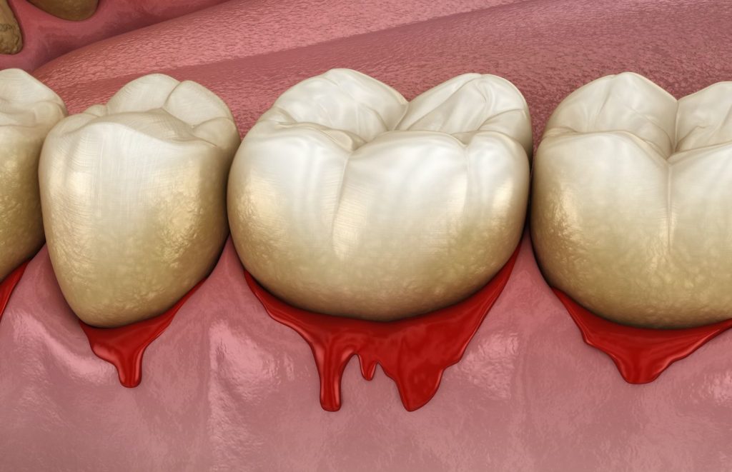 closeup of bleeding gums gum disease treatment dentist in Glyndon Maryland