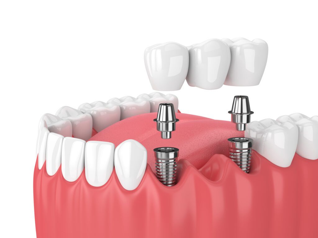 Multiple Dental Implants in Glyndon, MD