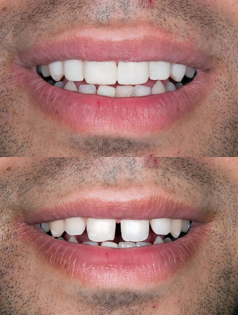 Crooked Teeth in Glyndon MD could be treated using a variety of treatment options