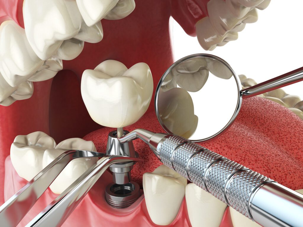 Dental Implants in Glyndon MD can help restore your bite, but they may not be for everyone